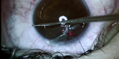 El 90% de las enfermedades oculares se puede prevenir