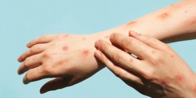 �Para el Uruguay de momento no es problema y quiz� nunca lo sea, el nuevo brote de Viruela del Mono� sostuvo el m�dico infect�logo, Eduardo Savio