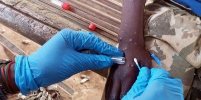 La Organizaci�n Internacional para las Migraciones solicita fondos para responder al aumento de casos de mpox