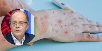 Informaci�n sobre la viruela del mono 