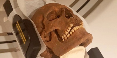 Un estudio revela que la poblacin de la poca vikinga de Suecia parece haber sufrido graves enfermedades orales, nasales y maxilofaciales