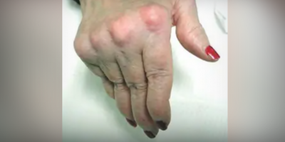 Abren vías al diagnóstico precoz de la artritis reumatoide tras hallar nuevas estructuras de la articulación de la mano