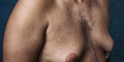 Hombres demandar�n a laboratorio por medicamento que les hizo crecer senos