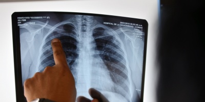 Disminuyen los casos de Tuberculosis en Uruguay