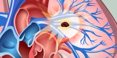 Buscan concientizar a la poblaci�n acerca de la trombosis