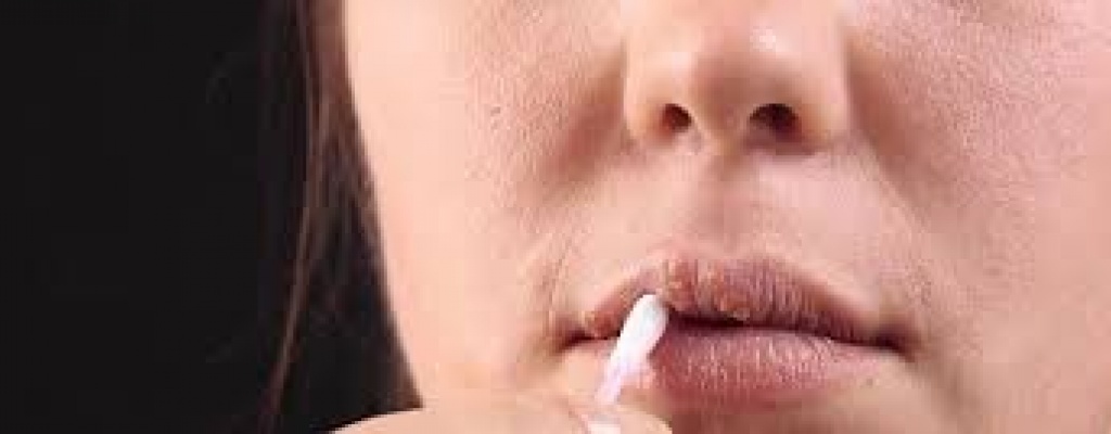 El virus del herpes labial est� activo y no presenta s�ntomas
