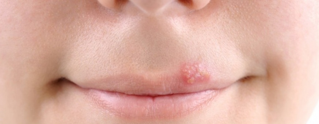 Ms del 60% de la poblacin de menos de 50 aos sufre herpes 