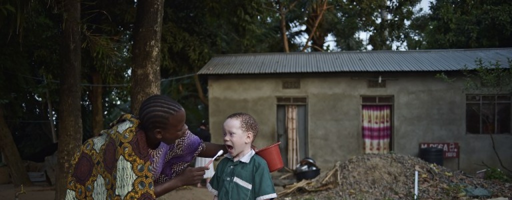 Jornada internacional de los albinos, minor�a perseguida en �frica