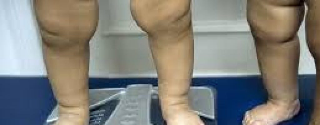 Ni�os obesos podr�an mostrar se�ales tempranas de problemas cardiacos
