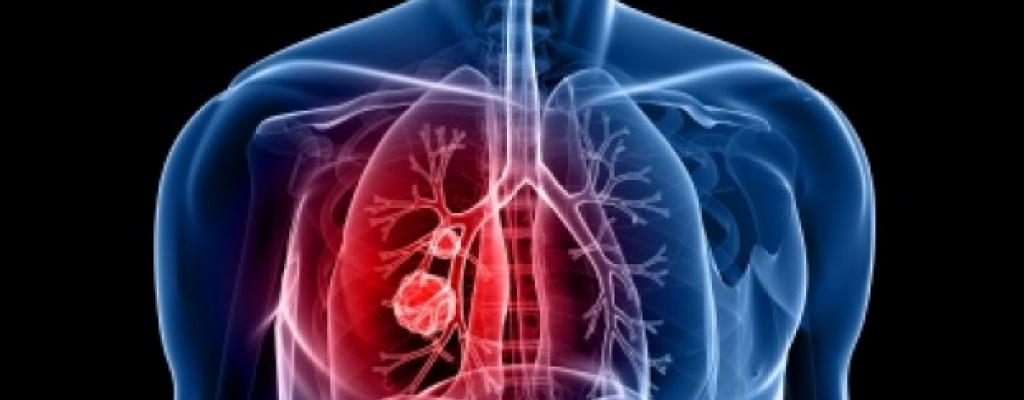 M�dicos logran detectar c�ncer pulmonar con an�lisis de sangre